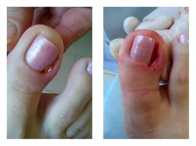 Удаление ногтевой пластины - «Как я пережила 5 операций с рецидивом после  каждой? Метод с 100% гарантией избавления от вросшего ногтя! » | отзывы
