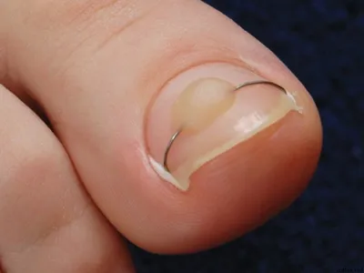 Удаление вросшего ногтя в Орле - Эс Класс Клиник
