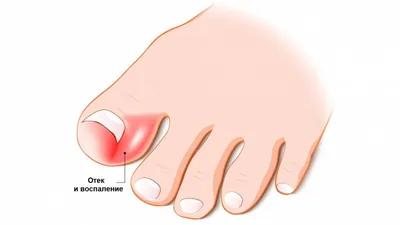 Последствия после удаления вросшего ногтя хирургом | Nails_by_panyushkina |  Дзен