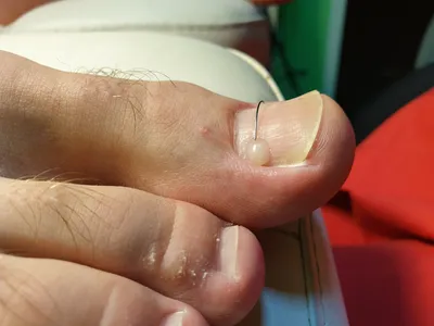 Лечение и резекция вросшего ногтя- Клиника CALM