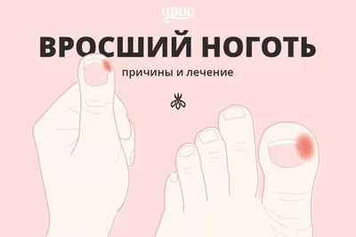 Резекция ногтевой пластины- эффективна ли она? | Московская Клиника  Подологии