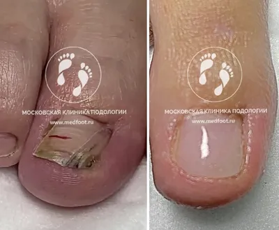 Удаление вросшего ногтя в Москве|Стоимость операции в клинике|удалить вросший  ноготь по низкой цене