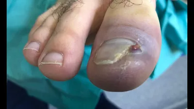 Боль после удаления вросшего ногтя