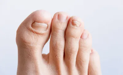 Вросший ноготь на большом пальце ноги. Лечение