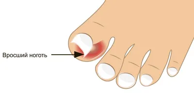 Дистрофия ногтевой пластины после удаления ногтя | Московская Клиника  Подологии