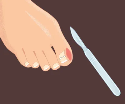 Удаление ногтевой пластины - «Вросший ноготь после регулярного педикюра » |  отзывы