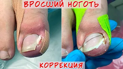 Хирургическое лечение вросшего ногтя в Хабаровске