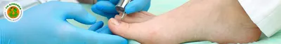 Исправляем ногтевые пластины после хирургического вмешательства |  Московская Клиника Подологии