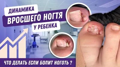 Вросший ноготь у ребенка | Услуги Подолога, Москва, Подольск, Щербинка