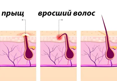 Вросший волос образовалась шишка: причины, что делать, лечение