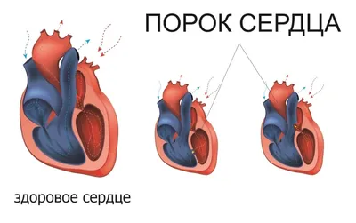 Порок сердца: что это, виды, симптомы, диагностика, лечение, профилактика