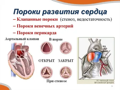 Порок сердца: что это, виды, симптомы, диагностика, лечение, профилактика