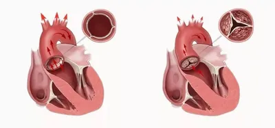 Краткий обзор врожденных сердечно-сосудистых аномалий (Overview of  Congenital Cardiovascular Anomalies) - Педиатрия - Справочник MSD  Профессиональная версия