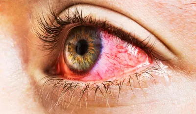 Кератит глаз: лечение, симптомы, классификация