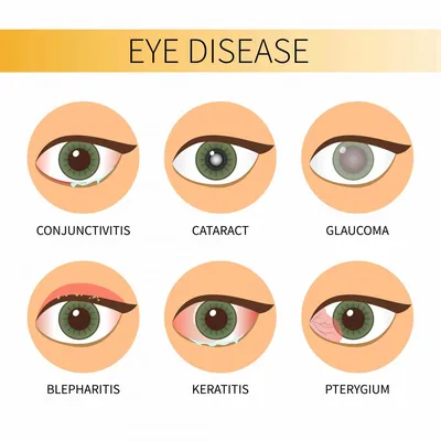 Болезни глаза у человека – список глазных болезней, их описание, симптомы и  лечение