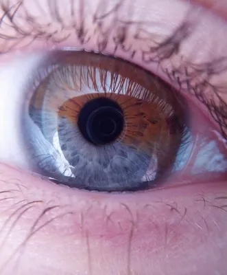 Безопасно ли менять цвет глаз? Кератопигментация, взгляд