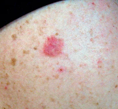 Фото и описание лечения базально-клеточный рак кожи лица методом ФДТ.