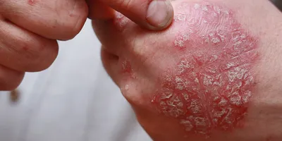Сыпь на коже у ребенка – причины и методы лечения