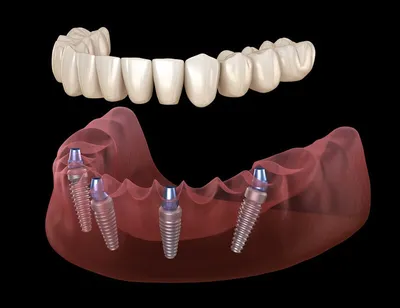 Съемные протезы – цена в Ставрополе