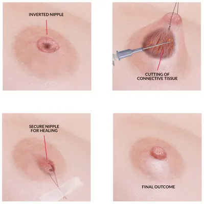Втянутый сосок и его хирургическая коррекция