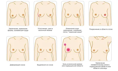 Клинические проявления рака молочной железы