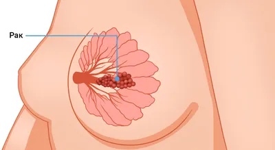 Первые признаки и симптомы рака молочной железы