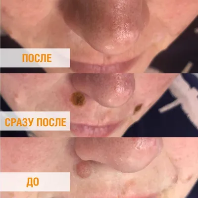Удаление бородавок жидким азотом в Москве | Цены на крио удаление бородавок  в Клинике подологии Полёт