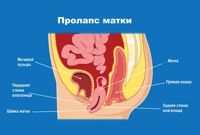 Перинеотомия. Эпизиотомия. Амниотомия - презентация онлайн