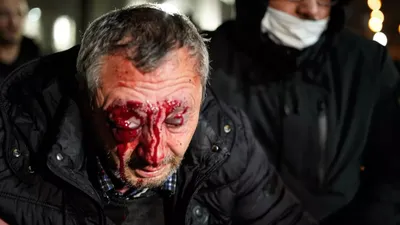 Участник акции протеста в Тбилиси потерял зрение на один глаз