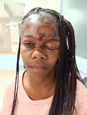 Мужчина выбил глаз 25-летней красотке за то, что она не ответила на его  приставания