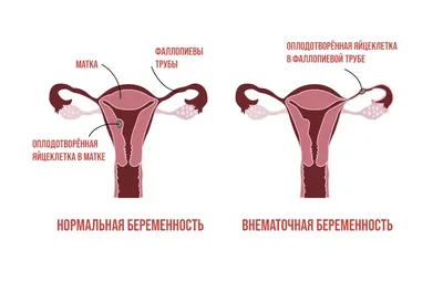 Первые признаки беременности после зачатия | Буду лучшей мамой с ФЭСТ | Дзен