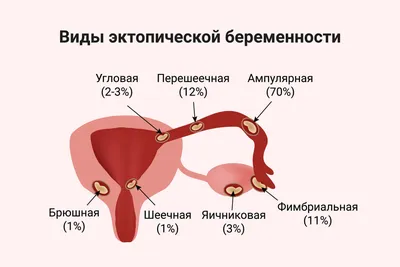 Внематочная беременность: симптомы, методы диагностики и лечения.