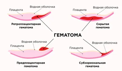 Поздняя имплантация эмбриона и ХГЧ при ЭКО: признаки и симптомы имплантации