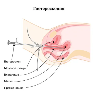 Прерывание внематочной беременности – стоимость операции в клинике  Санкт-Петербурга