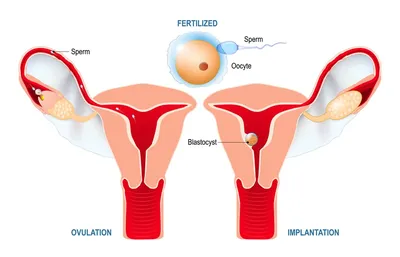 Как прикрепляется эмбрион при ЭКО? Шансы на успешную беременность.