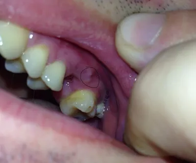 Твёрдое образование на десне - Вопрос стоматологу - 03 Онлайн