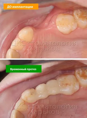 О стоматологии и не только...: Расширение верхней челюсти. Лечение  брекетами.