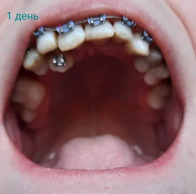 О стоматологии и не только...: Смещенный центр зубов. Как исправить?
