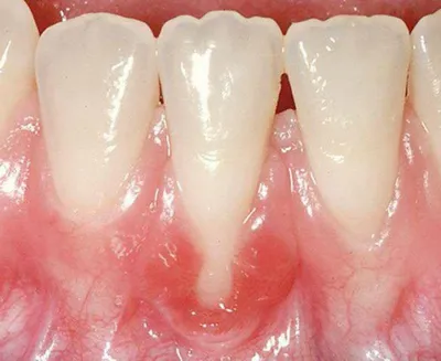 Кость царапает щеку после удаления зуба (?) - Вопрос стоматологу - 03 Онлайн