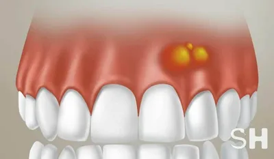 Экзостоз после удаления зуба, выпирает кость что делать?