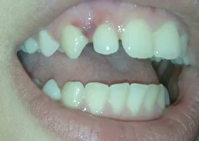 корень 32 зуба вышел под десну, кортикальная пластинка исчезает -  Ортодонтия - Стоматология для всех