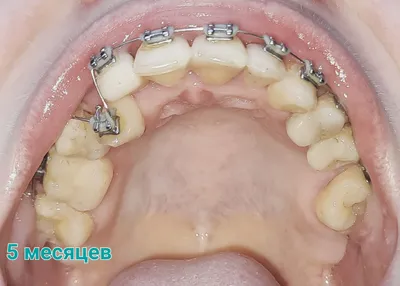 Коронки и мосты на зубы