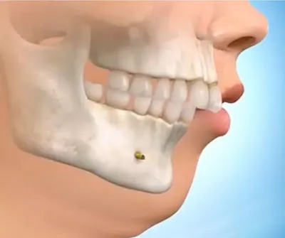 Лечение кисты зуба в Москве цены | Симптомы, причины и методы удаления
