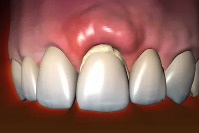 Нарост на десне: методы лечения, причины образования и удаление