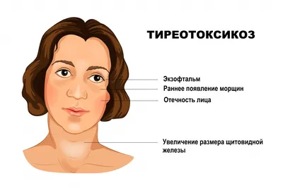 Глазистый человек с болезнью Грейвса токсичный диффузный зоб, гипертиреоз.  Увеличенная щитовидная железа и выпученные глаза экзофтальмоса. Заболевания  эндокринной системы, эндокринология. стоковое фото ©GarnaZarina 465207736