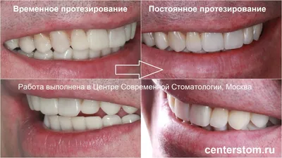 ᐉ Виниры на зубы в Одессе • Цена • Установка виниров в Одессе | PhilDent