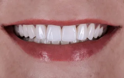 Винир - это возможность улучшения улыбки с помощью индивидуальных зубных  нарядов