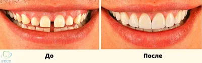 Laminate Veneers | Diamond Dental Antalya