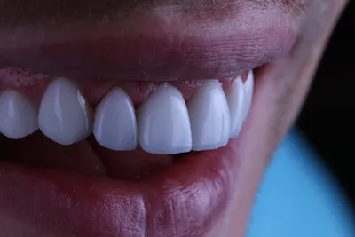 Накладки на верхние, нижние и жевательные зубы для выравнивания прикуса
