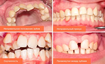 Виниры | NeoLifeDental